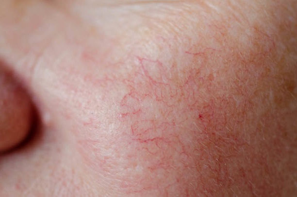 Arañas Vasculares en la Cara: Causas, Síntomas y Tratamientos