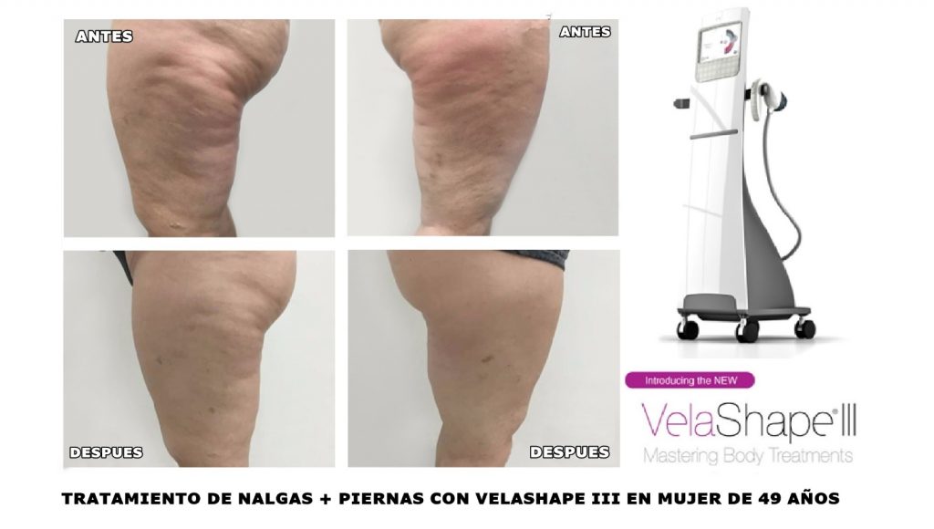 Tratamiento nalgas y piernas con Velashape III